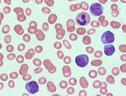 plasmacytoid